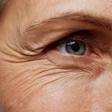 Kråksparkar (linjer runt ögonen)